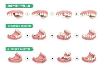 单颗多颗全口种植牙方案示意图