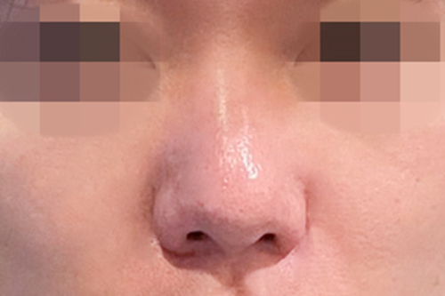 韩国TS整形医院做完隆鼻手术7个月了，上图给大家说真相！