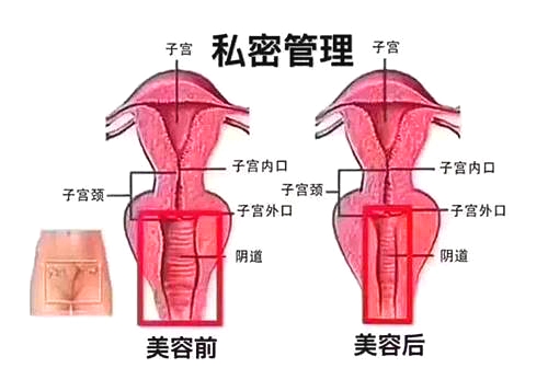 乌鲁木齐外阴整形手术示意图