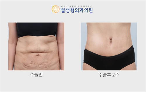 迷你腹壁整形手术介绍,分享韩国腹壁迷你小拉皮手术!