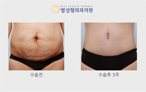 迷你腹壁整形手术介绍,分享韩国腹壁迷你小拉皮手术!