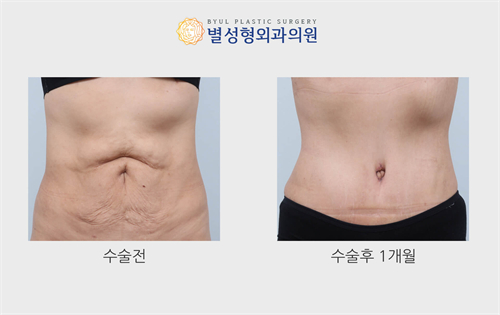 韩国星愿整形外科腹壁整形手术对比照