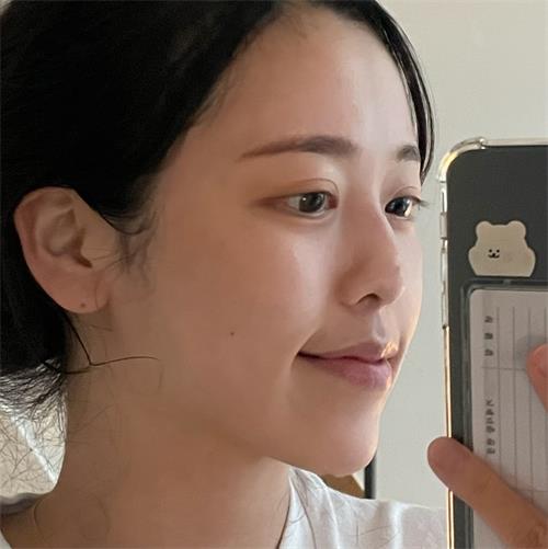 韩国JUST整形外科隆鼻+猫脸术整形手术前