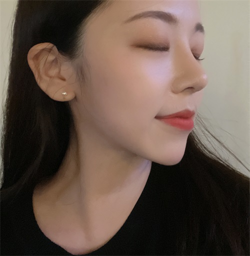 韩国JUST整形外科隆鼻+猫脸术整形术后对比