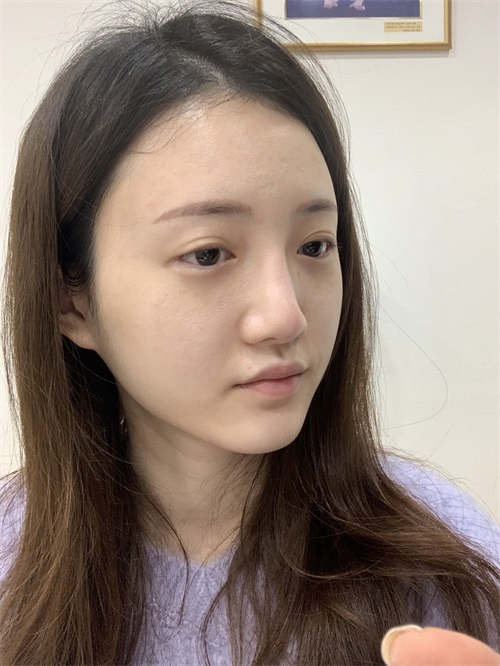 韩国KOKO整形医院鼻子+脂肪填充+颧骨整形术前