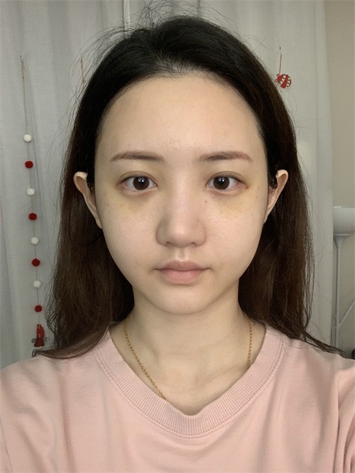 韩国KOKO整形医院鼻子+脂肪填充+颧骨整形术后2周正面