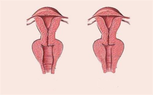 阴道缩紧手术示意图