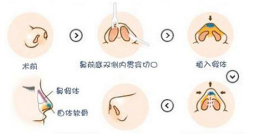 肋骨鼻综合示意图