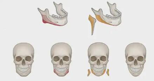 下颌角整形展示照片