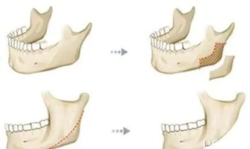 下颌角整形改善治疗展示