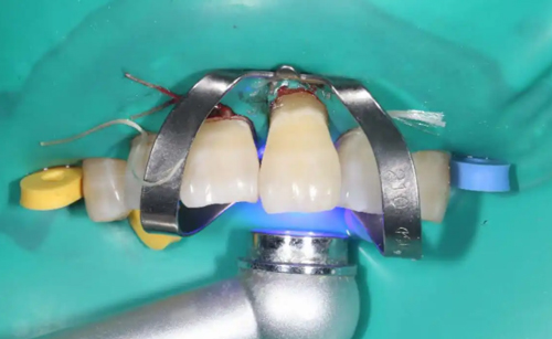 种植牙手术过程图