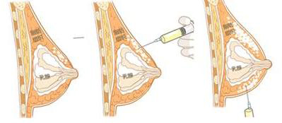自体脂肪丰胸示意图