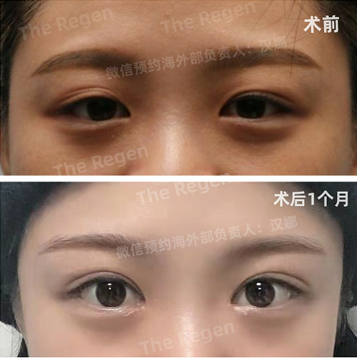 韩国德丽珍整形眼睛提升手术前后图