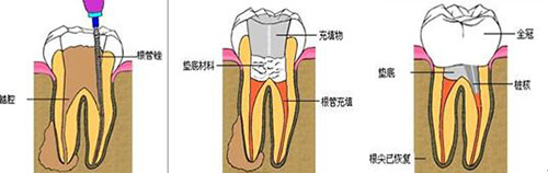 根管治療示意圖