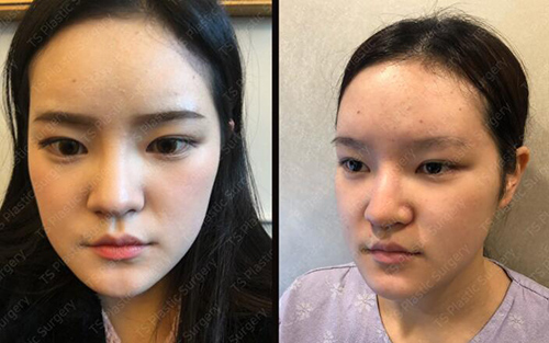 在韩国做全脸改造有多惊艳？TS整形外科真人手术分享！