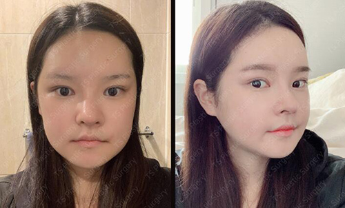 韩国TS整形外科全脸整形恢复期