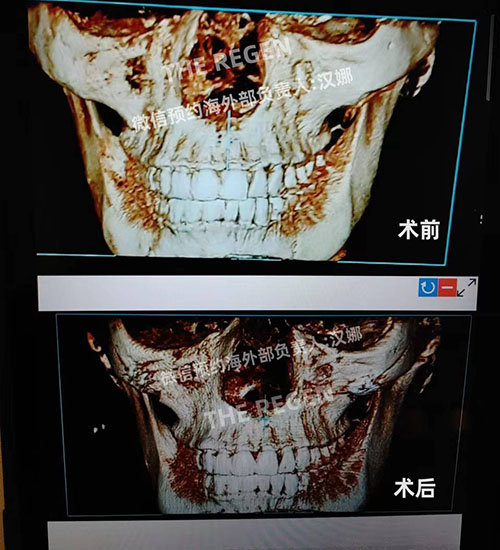 韩国德丽珍整形医院颧骨内推术前后