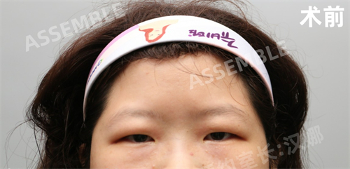 韩国德丽珍整容外科眼部整形术前图