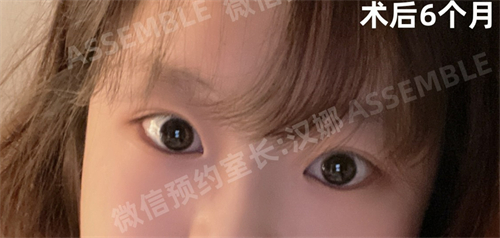 韩国德丽珍整容外科眼部整形术后图
