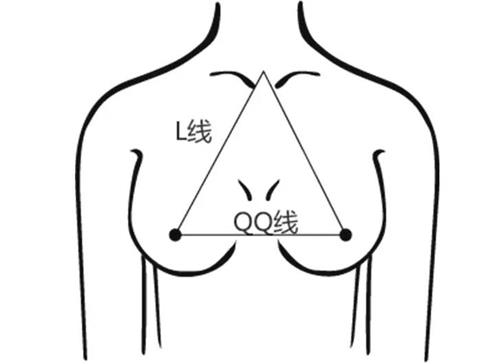 贵阳美莱医疗美容隆胸示意图