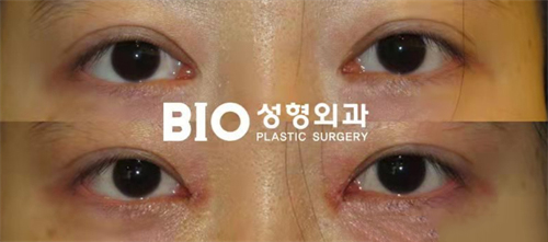 韩国BIO整形外科眼部整形对比照