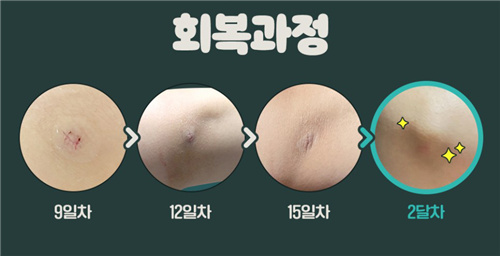 韩国WJ原辰整形外科手臂吸脂创口变化
