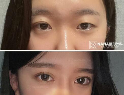 韩国NANA娜娜整形外科眼睛手术