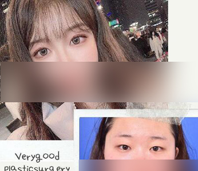 韩国VG百利酷整形外科眼部手术
