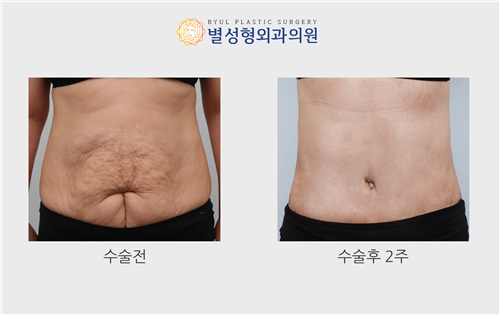 韩国腹壁成形术多少钱?附迷你腹壁整形和腹壁成型价格表!