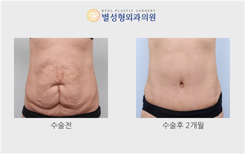 韩国星愿整形外科腹壁成形术对比