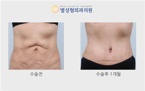 韩国星愿整形外科腹壁成形术前后照