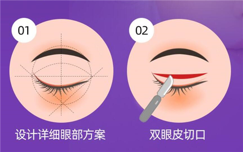 杭州維多利亞整形醫(yī)院眼整形圖