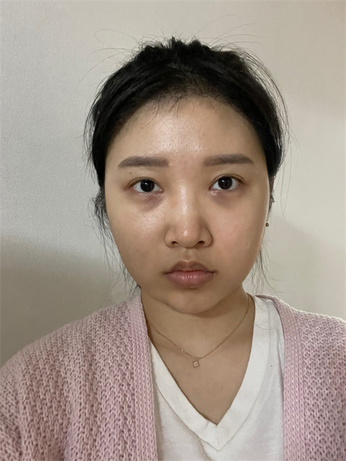 韩国VIBE整形外科眼鼻整形术前图片展示