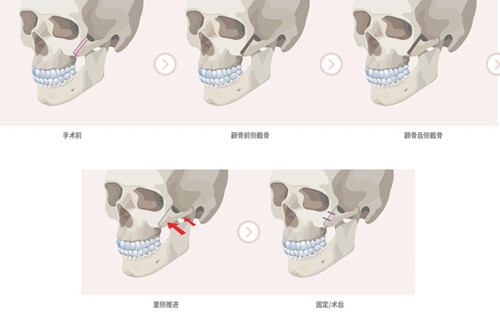 韩国VG百利酷整形颧骨缩小怎么样?手术具体特色分享