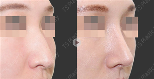 韩国TS整形外科鼻部手术改善中面部过长
