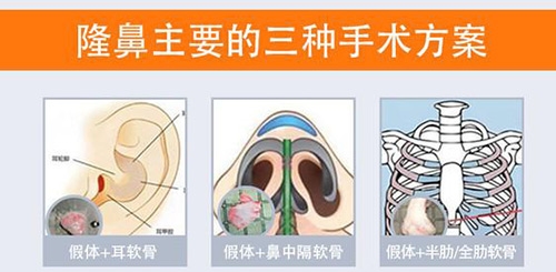 隆鼻手术方案示意图