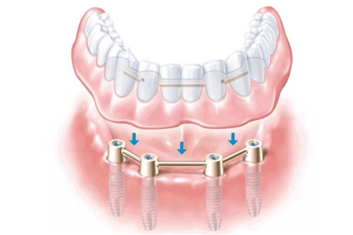 all-on-4種植技術(shù)