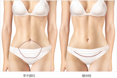韩国WJ原辰腹壁整形了解一下,拯救你的下垂“小肚腩”!