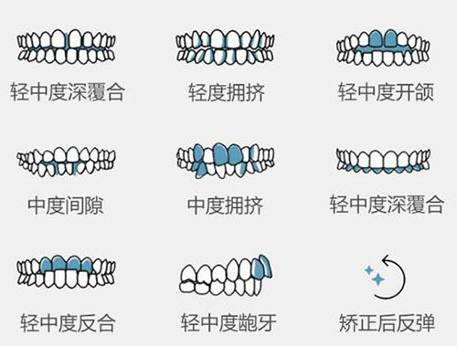 哪些牙齿要做正畸