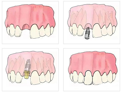 种植牙过程示意图