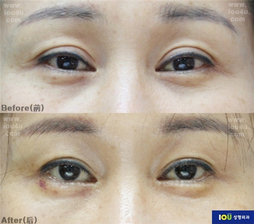 韩国IOU整形外科栓眼皮宽改窄对比照