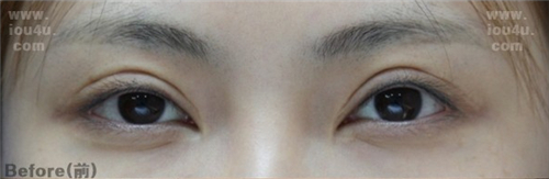 韩国IOU整形外科眼修复术前图