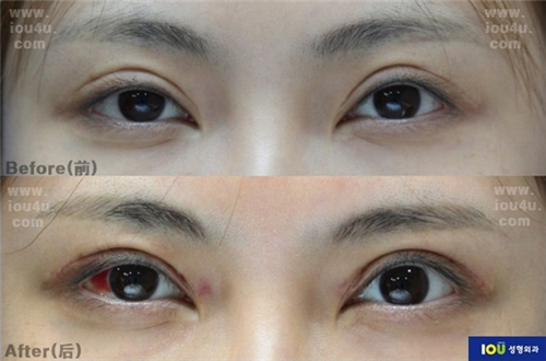 韩国IOU整形外科眼修复对比照