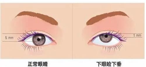 濟南諾德整形眼部矯正圖