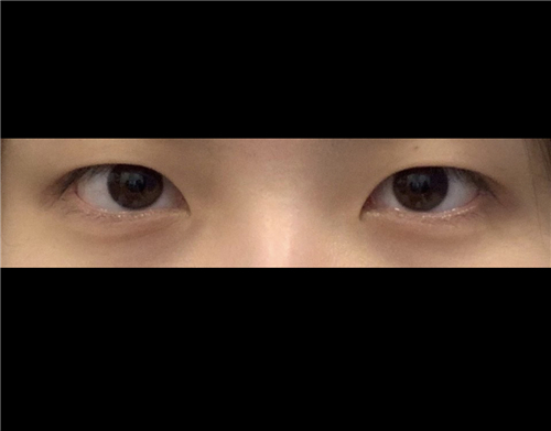 韩国爱护整形外科双眼皮手术前