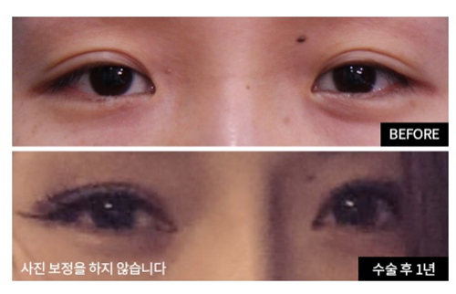 韩国爱护整形外科双眼皮手术对比照