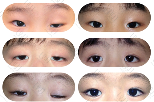 重度眼睑下垂怎么治疗?韩国WJ原辰的CFS重度眼睑下垂技术牛!