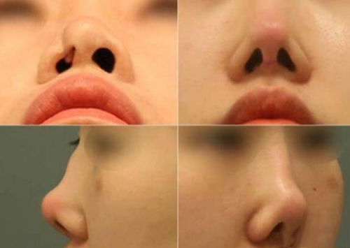 韩国欧佩拉做鼻子修复怎么样?针对这几种鼻型院内做的好!