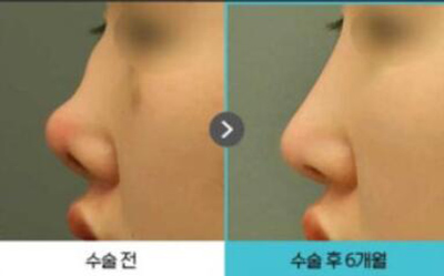 韩国欧佩拉鼻修复前后对比