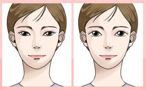 年轻女性割双眼皮前后差异